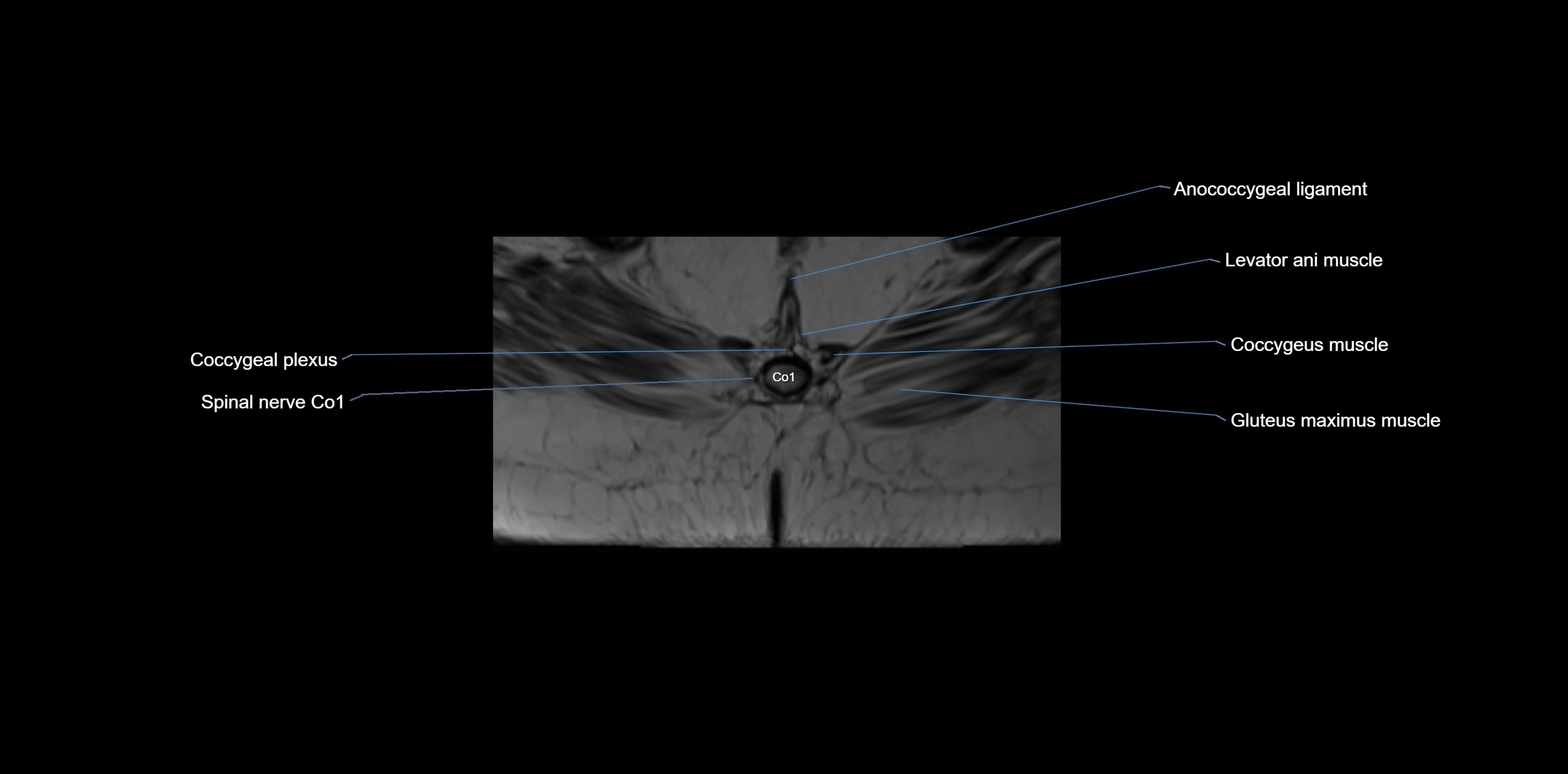 MRI sacrum, coccyx and sacroiliac joint axial cross sectional anatomy 3T  radiology  image-img-00001-00073.webp